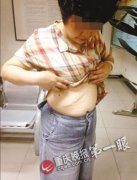 1993年,她在一家医院做肾上腺肿瘤手术 1998年,她在另一家医院