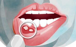 口腔大面积溃疡是什么原因 老年人长期口腔溃疡是什么原因