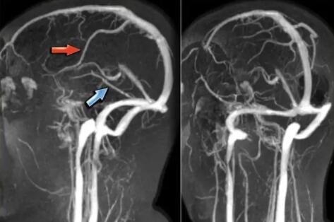 脑静脉血栓实现智能化诊断,脑卒中AI研究成果登上顶级期刊《Stroke》