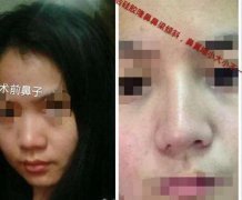 妙龄女整形后鼻孔一大一小 维权院方称非医疗事故